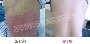 银屑病有哪些具体病因