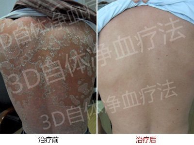 最常见的老年银屑病症状