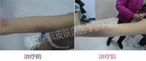 关节型牛皮癣应该如何诊断