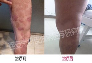银屑病发病病因有哪些