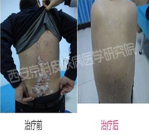 背部银屑病初期表现