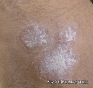 如何诊断出脓包型银屑病