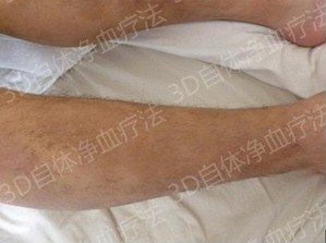治疗后