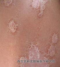 哪些是银屑病症状