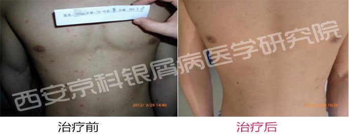 银屑病怎样治疗
