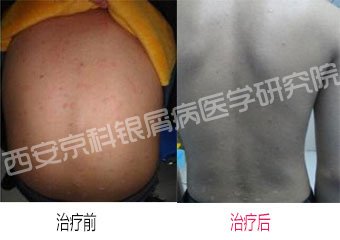 银屑病症形成病因