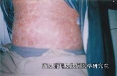 银屑病要和哪些疾病鉴别开