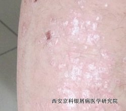 红皮型牛皮癣怎么治