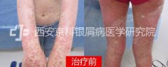 花样少女饱受15年银屑折磨,一朝治愈喜极而泣