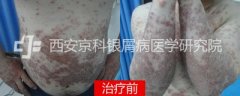 赶走银屑病,做回阳光少年