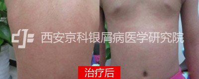 治好银屑病,9岁女孩重获快乐人生