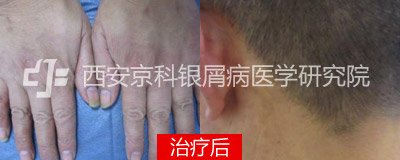 规范诊疗,助知命之年患者战胜老“牛”